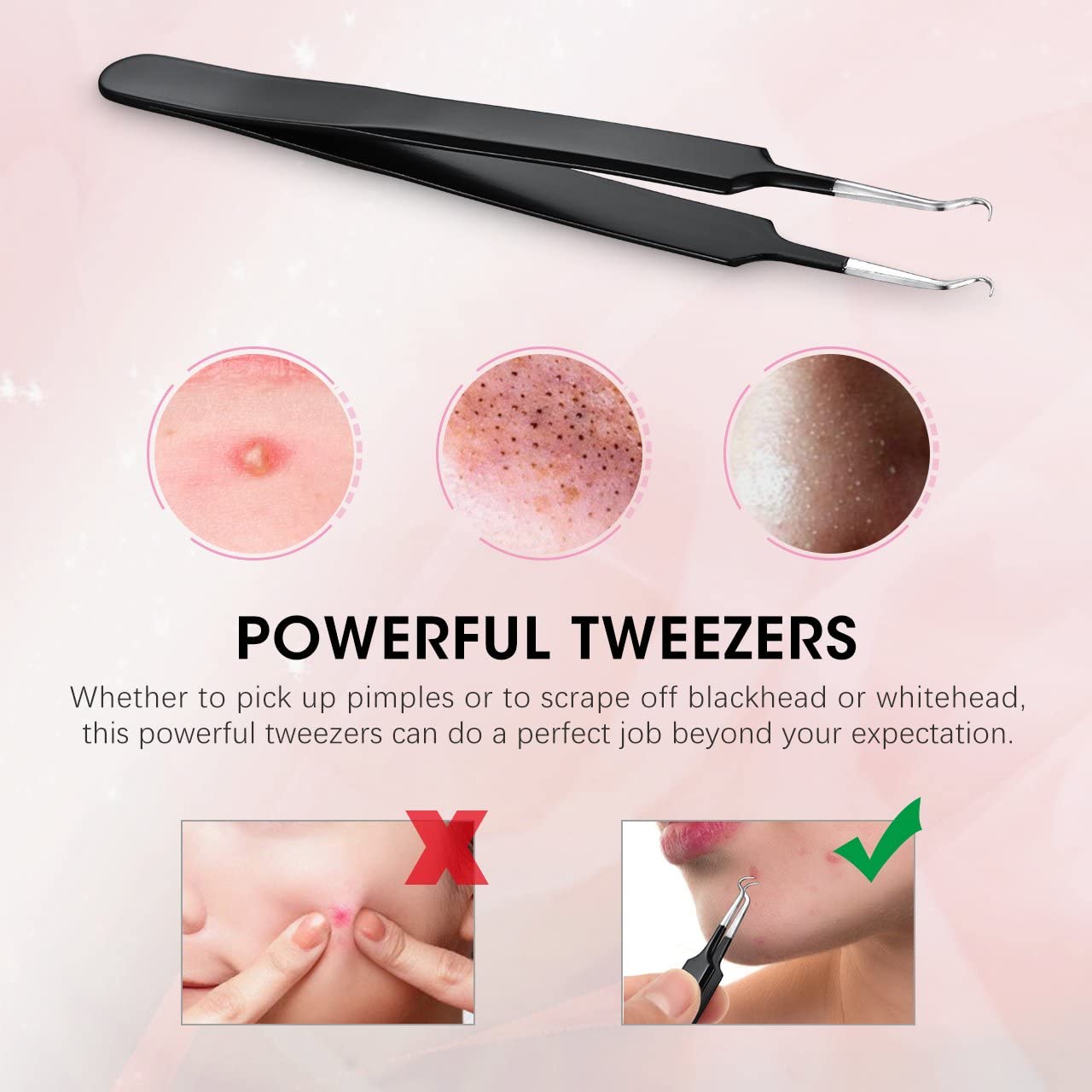 ATMOKO ELLESYE 6-Piece Blackhead Remover Tool Kit – Stainless Steel Pimple Popper Set